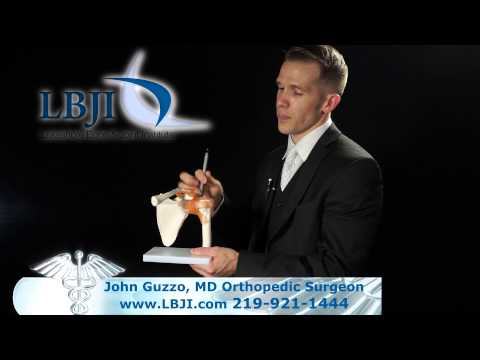 Dr. John Guzzo Explains Rotator Cuff Tears