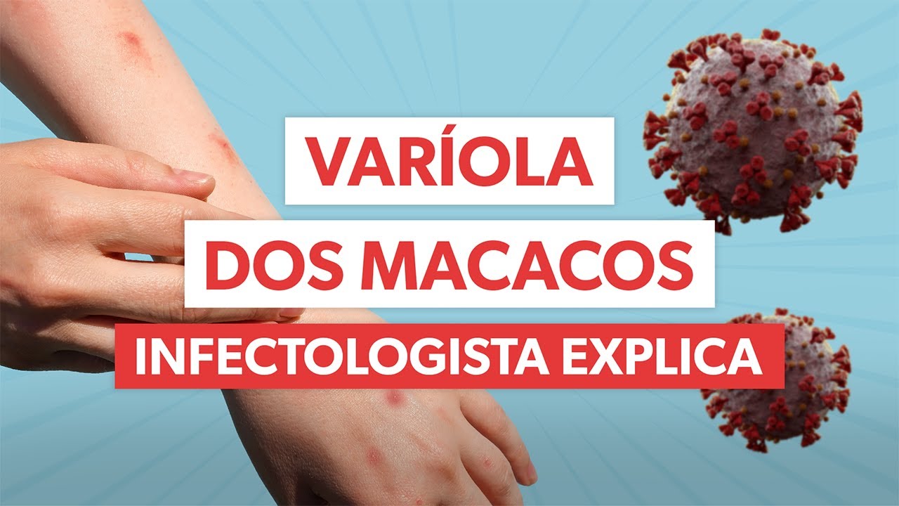 VARÍOLA DOS MACACOS: principais sintomas e como se proteger.