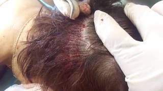 FUE Hair Transplantation unshaven extraction by Dr. Anastasios Vekris (video)