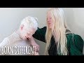 The Besties With Albinism | BORN DIFFERENT