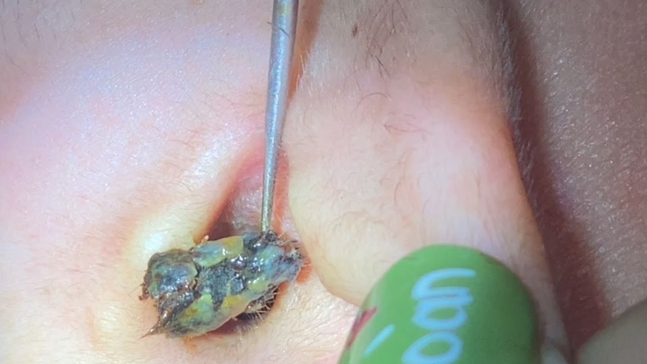 ASMR耳掃除: 耳垢耳掃除耳垢除去 | 耳かき 5