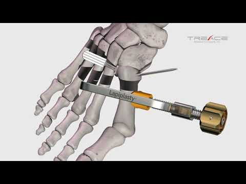 Lapiplasty® surgical technique -- how it works