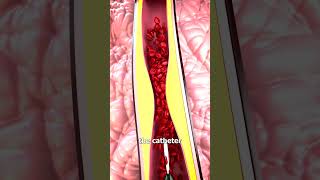 Download lagu How Heart Stents Work 🤔 mp3