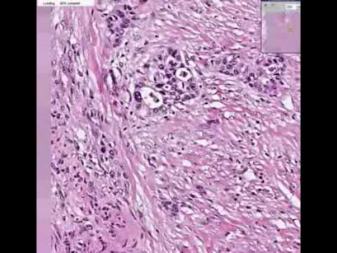 Sarcoma cancer de piel