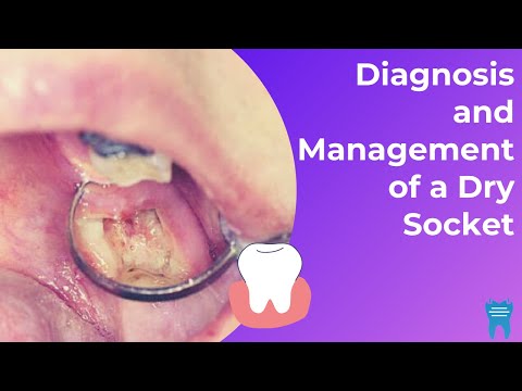 What is a Dry Socket? | Diagnosis and Management