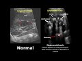 Kidney, Ureter and Bladder (KUB) Ultrasound Normal Vs Abnormal Image Appearances Comparison