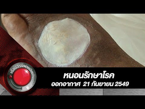 การอดอาหารกลาก รักษากลากโซดา
