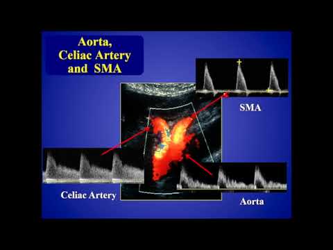 Mesenteriale Ischämie