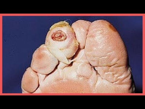 Rissig Gelenk des Daumens Muskeln und Gelenke Ache HIV