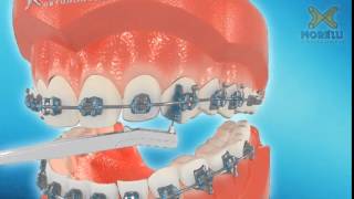 Como usar a escova interdental para higienização do aparelho Ortodontico - Dentare