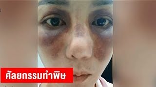เจ้าของคลินิกศัลยกรรมขอโทษ-รับผิดชอบ ตร.หญิง หลังทำจมูกแล้วลามช้ำไปทั้งหน้า