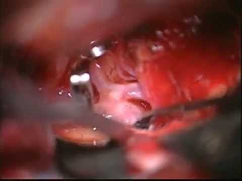 AComA: Clipping of AcomA ruptured aneurysm
