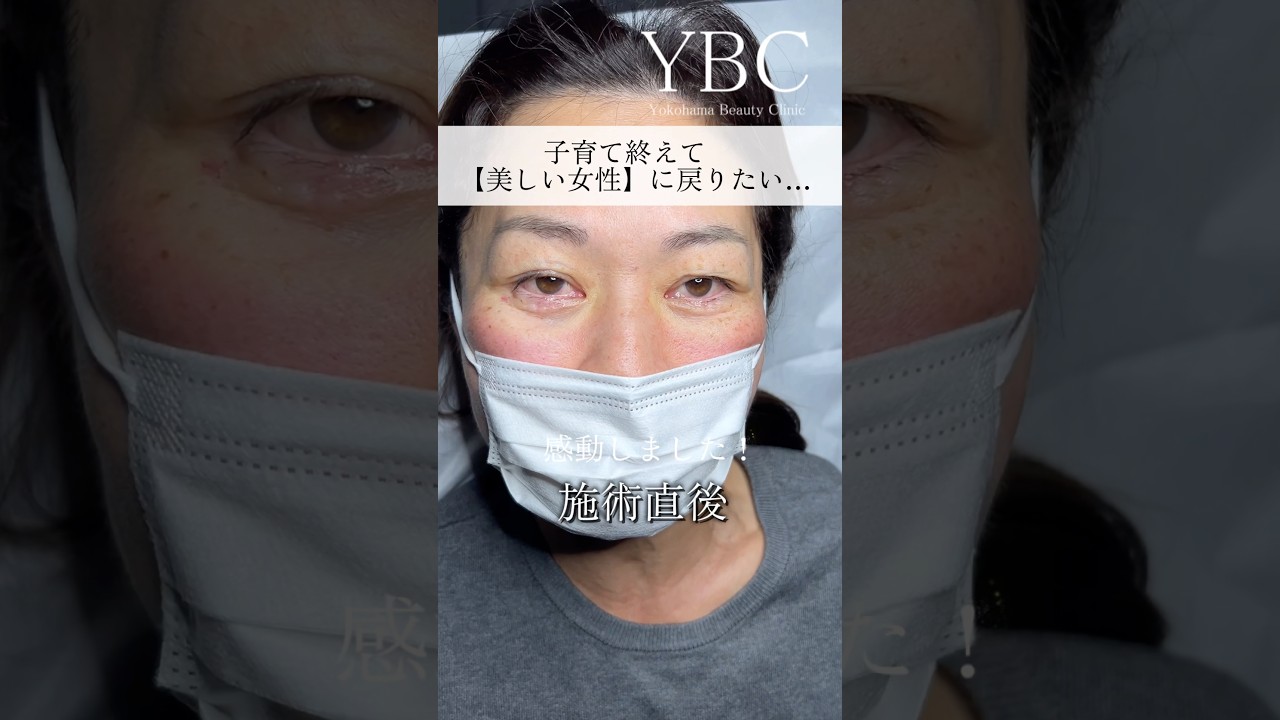 また女性になりたい#美容 #クマ取り #目の下のクマ #整形 #ybc横浜美容外科 #イソセン#若返り
