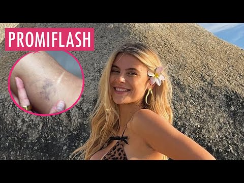 Video Thumbnail: Romina Palm hat durch Schwangerschaft Besenreiser bekommen