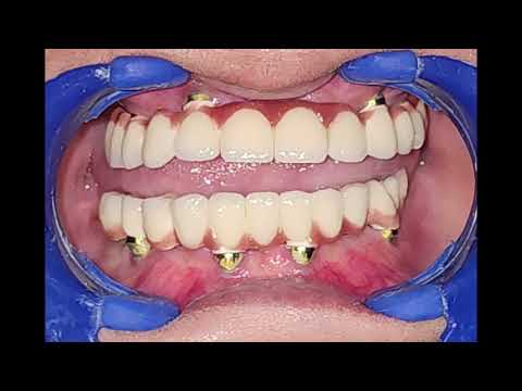 dental implants @DeccanDentics