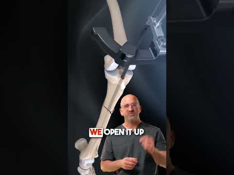 Tibia Fracture Hammer & Nail 🔨 #shorts