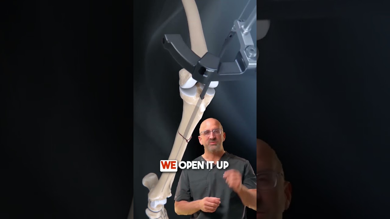 Tibia Fracture Hammer & Nail 🔨 #shorts