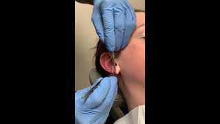 Ear Lobe Repair in Denver