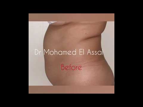 نحت البطن Vaser Liposuction