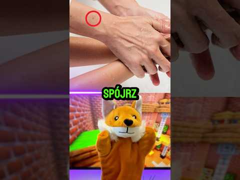 🔥 Tego pieprzyka ma 99% ludzi! Sprawdź, zanim zniknie!