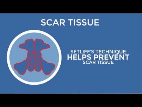 Possible Complications of Sinus Surgery