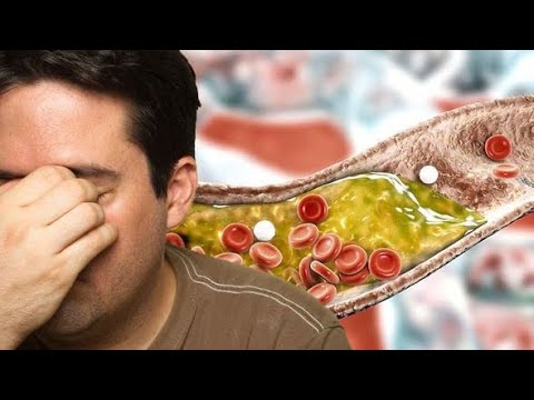 Simptomat e kolesterolit të lartë, këto janë shenjat paralajmëruese në ….