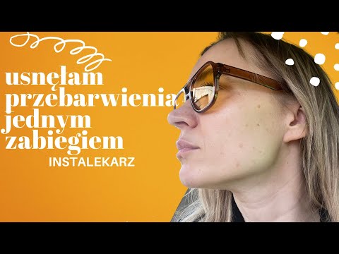 Usuwanie przebarwień z twarzy u Magdy Suchan