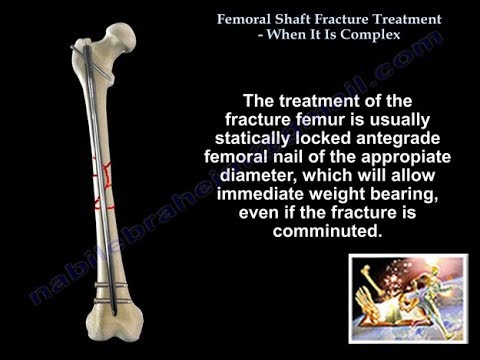Femoral Shaft Fracture When It Is Complex - Everything You Need To Know - Dr. Nabil Ebraheim
