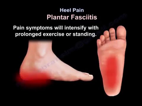 Understanding Heel Pain: Causes, Treatment, and Focus on Plantar Fasciitis