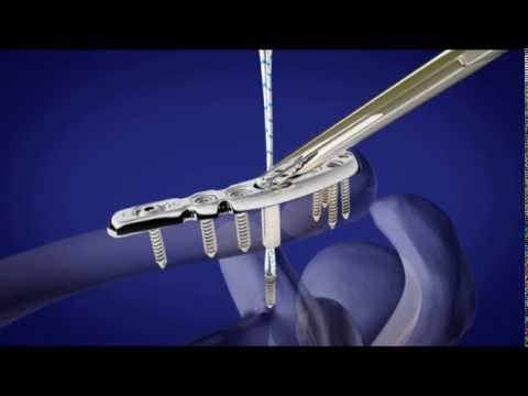 Rückenschmerzen bei einem Kind beim Springen Supination und Pronation des Schultergelenkes