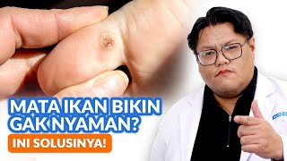 Download lagu Mata Ikan Bikin Tangan & Kaki Gak Nyaman? Ini Penyebab & Cara Mengatasinya! mp3 Download lagu Mata Ikan Bikin Tangan & Kaki Gak Nyaman? Ini Penyebab & Cara Mengatasinya! mp3