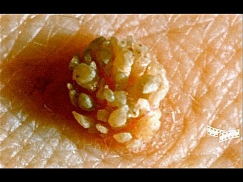 Parazita pinworm tünetei