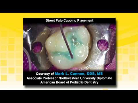 TheraCal LC as a Liner in a Class II Resin Based Composite Restoration