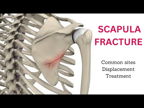 SCAPULAR FRACTURE | FRACTURE OF THE SCAPULA | SCAPULAR FRACTURE TREATMENT | LESS COMMON FRACTURE |
