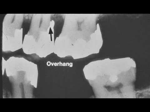 Dental Radiograph Pathology & Restorations (part 1)