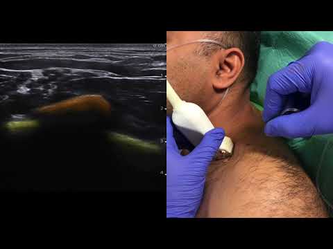 Ultrasound guided supraclavicular brachial plexus block