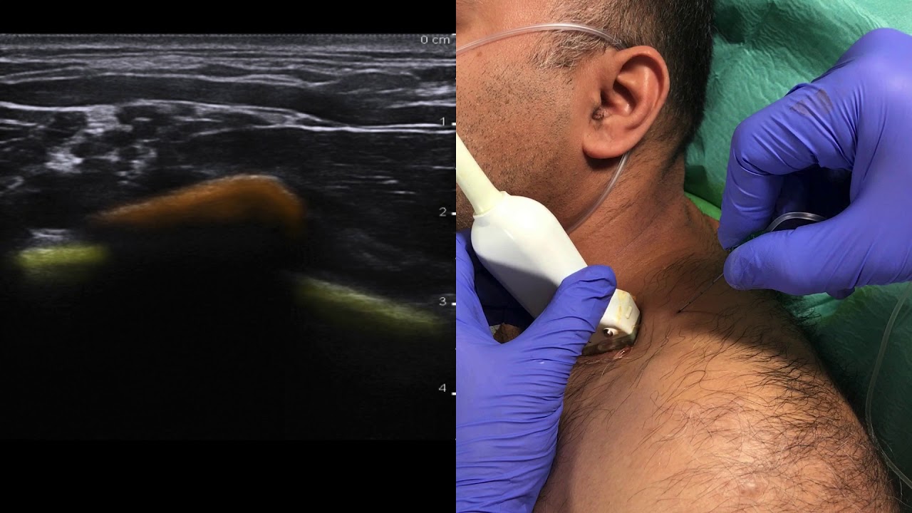 Ultrasound guided supraclavicular brachial plexus block