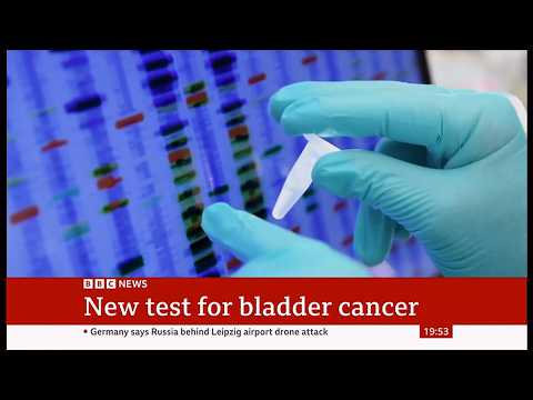 Urine test can spot more than nine in 10 bladder cancers ...