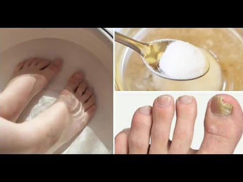 Cum să eliminați rapid ciuperca unghiilor de la picioare