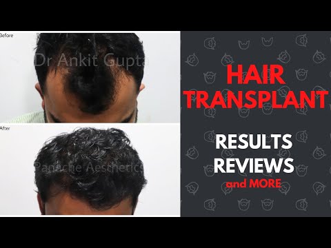 Hair Transplant Patient Review