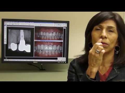 download lagu mp3 mp4 Dental Implants Tijuana Mexico, download lagu Dental Implants Tijuana Mexico gratis, unduh video klip Dental Implants Tijuana Mexico