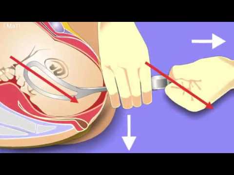 Forceps Delivery: Process, Benefits, & Risks Forceps Delivery: Process, Benefits, & Risks