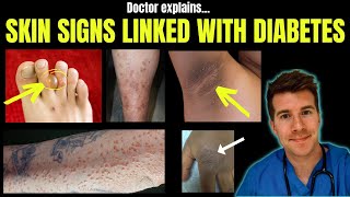Doctor explains 12 SKIN CONDITIONS associated with DIABETES
