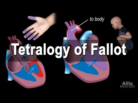 Congenital Heart Disease: Tetralogy of Fallot, Animation