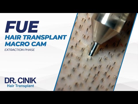 FUE Hair Transplant Macro Cam - Extraction Phase | Hair Transplant | Dr. Emrah Cinik