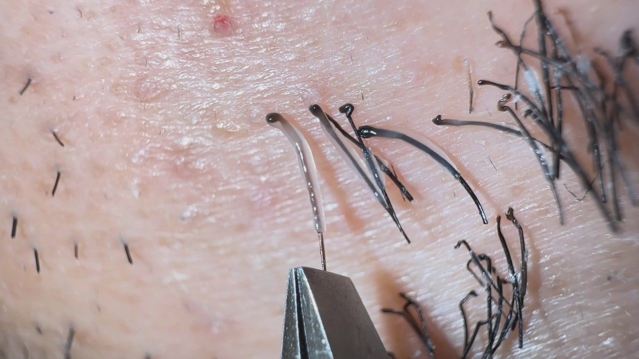 Plucking facial hair 1429 頬髭抜き