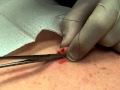 Mole Removal Surgery and Stitches 