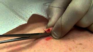 Mole Removal Surgery and Stitches