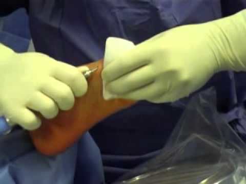 Clicca articolazioni delle gambe Carica con il video in hip coxartrosi