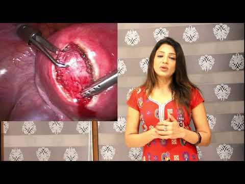 Causes And Treatment Of Fibroids